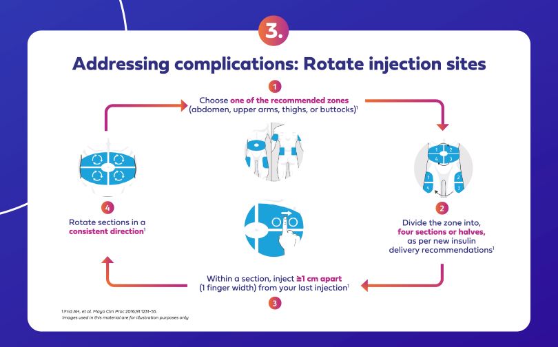 Rotate injections sites